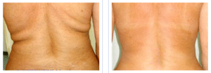 mesotherapy back fat before after